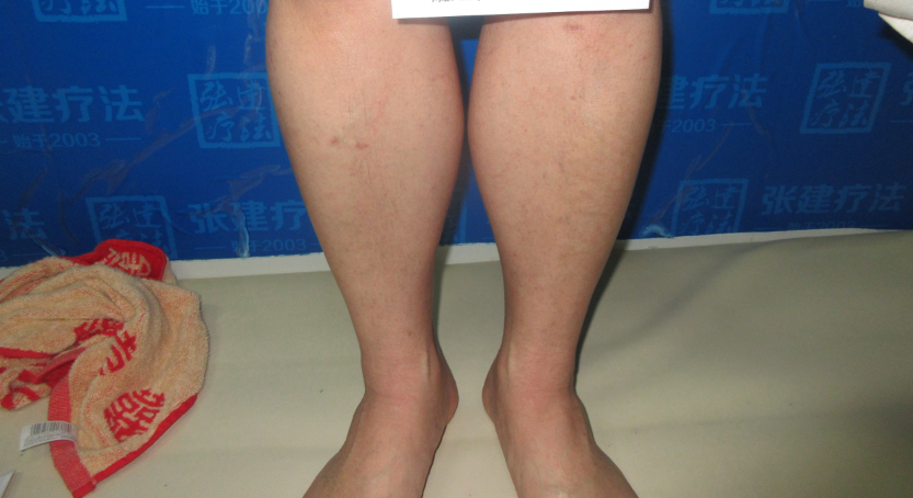 夏天魚(yú)鱗病