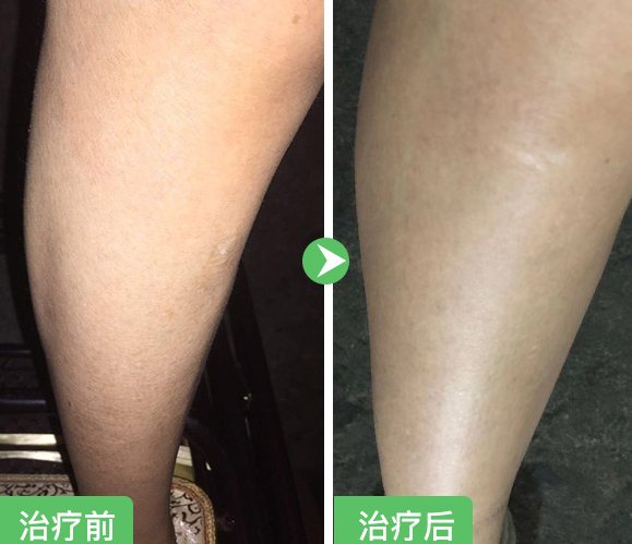 魚鱗皮膚怎么治